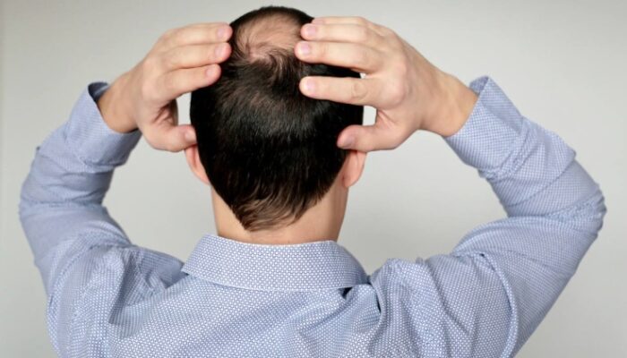 3 Insights for Men Struggling with Male Pattern Baldness