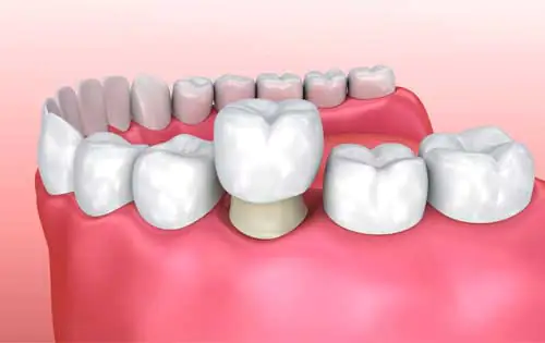 Unveiling The Brilliance Of Zoom! Teeth Whitening 