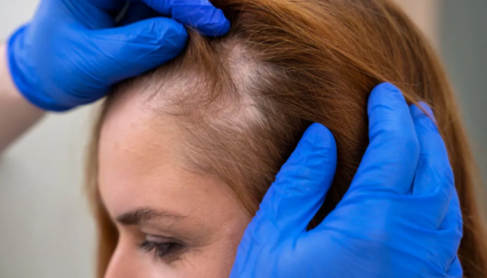 A Complete Hair Transplant Timeline for Regaining Confidence