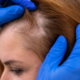 A Complete Hair Transplant Timeline for Regaining Confidence